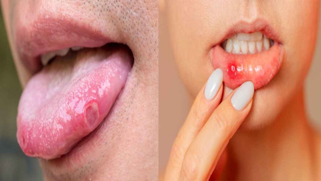 Mouth Ulcer Remedies in Hindi