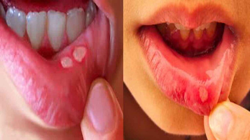 Mouth Ulcer Remedies In Hindi