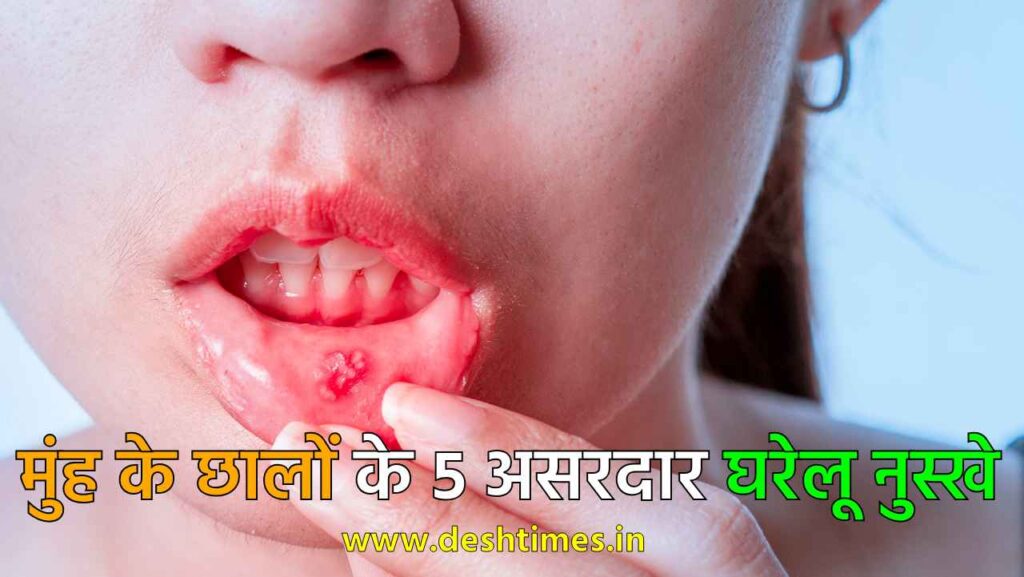 Mouth Ulcer Remedies in hindi